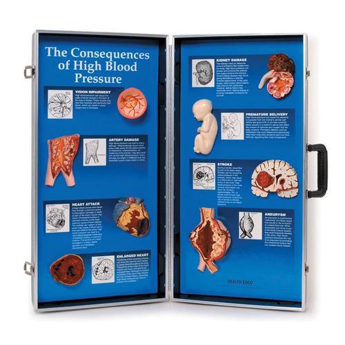Consequences of High Blood Pressure 3D Display, 1018277 [W43081], 심장 건강 및 운동 교육